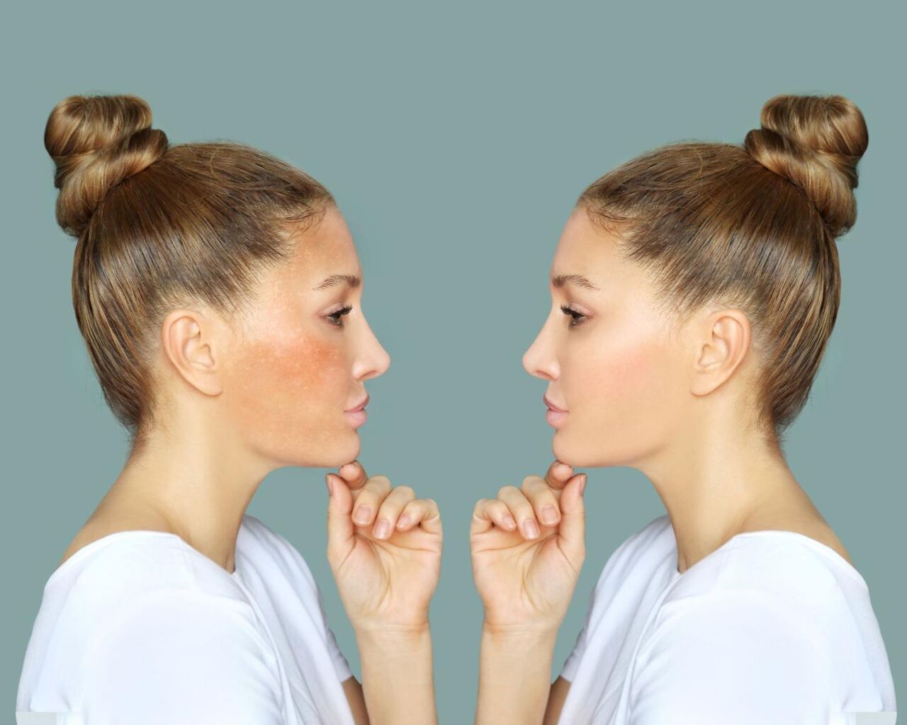 چگونه از لکههای تیره پوست خلاص شویم؟ چگونه از لکههای تیره پوست خلاص شویم؟