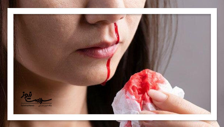 خونریزی بینی نشانه ای از این اختلال جدی در بدن خونریزی بینی نشانه ای از این اختلال جدی در بدن