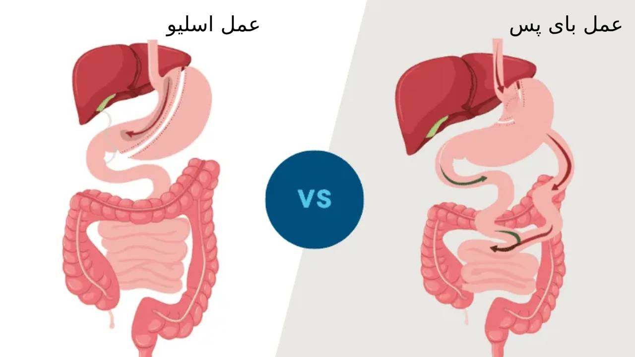 اسلیو معده: روشی موثر برای لاغری و کاهش وزن