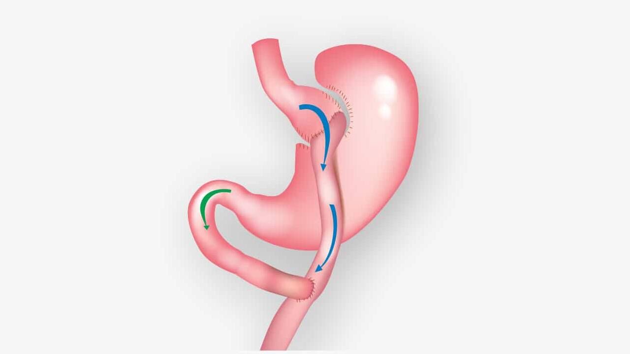 اسلیو معده: روشی موثر برای لاغری و کاهش وزن