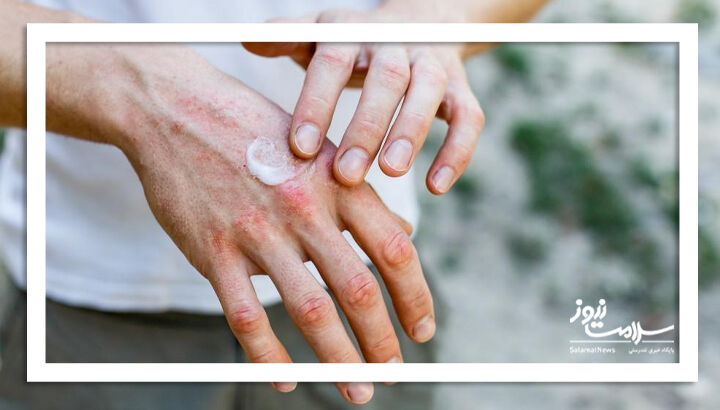 هوای آلوده و افزایش خطر ابتلا به اگزما هوای آلوده و افزایش خطر ابتلا به اگزما