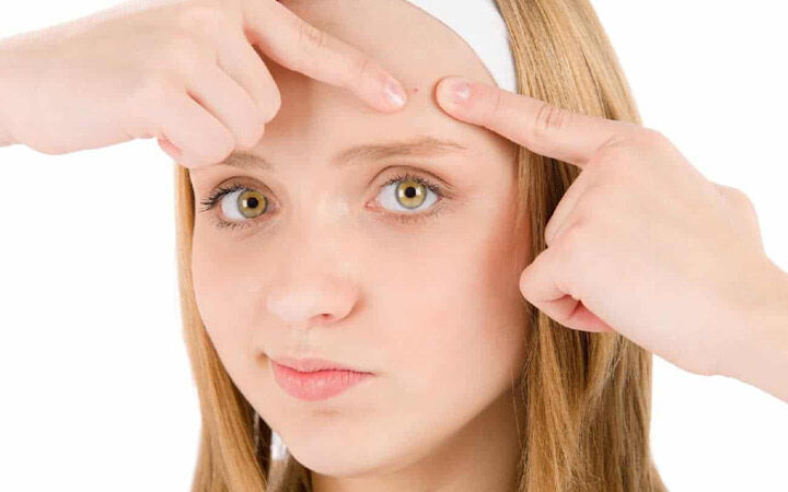 علت جوش پیشانی چیست و چگونه درمان میشود؟ علت جوش پیشانی چیست و چگونه درمان میشود؟
