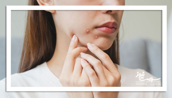 درمان موثر برای جوشهای دوران بزرگسالانی درمان موثر برای جوشهای دوران بزرگسالانی