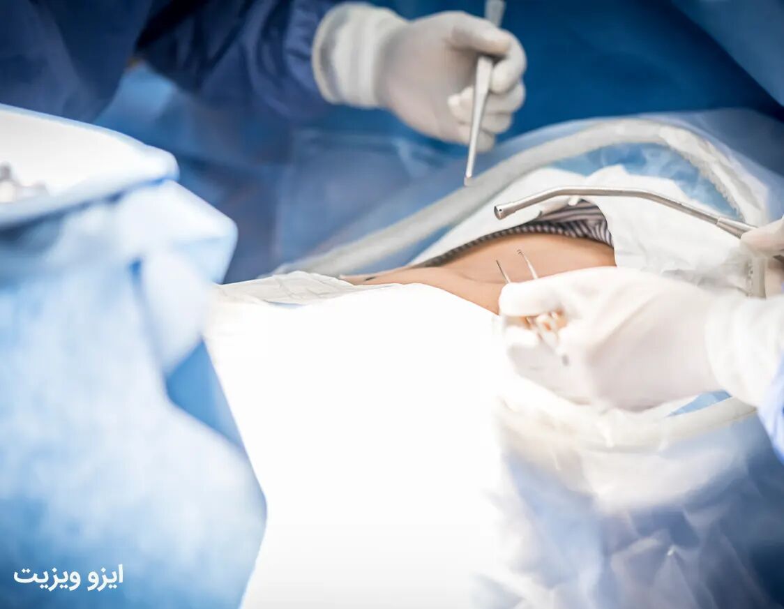 عمل اسلیو معده؛ هرآنچه باید از عمل اسلیو معده بدانید