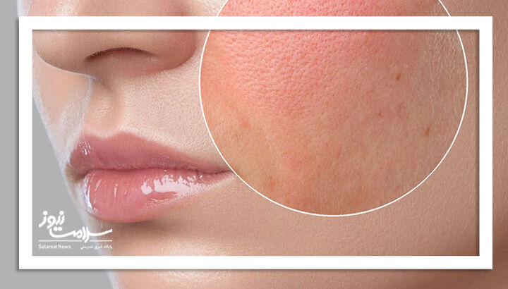 استرس جنگ باعث خشکی پوست میشود؟ استرس جنگ باعث خشکی پوست میشود؟