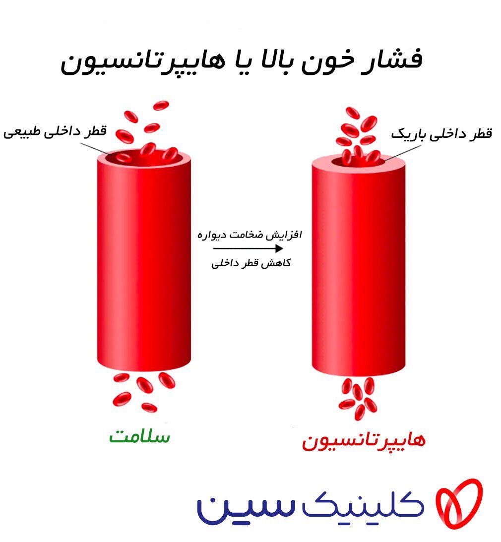 فشار خون بالا فشار خون بالا