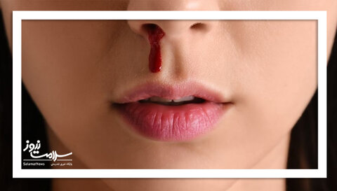 چگونه خون دماغ را بند بیاوریم؟