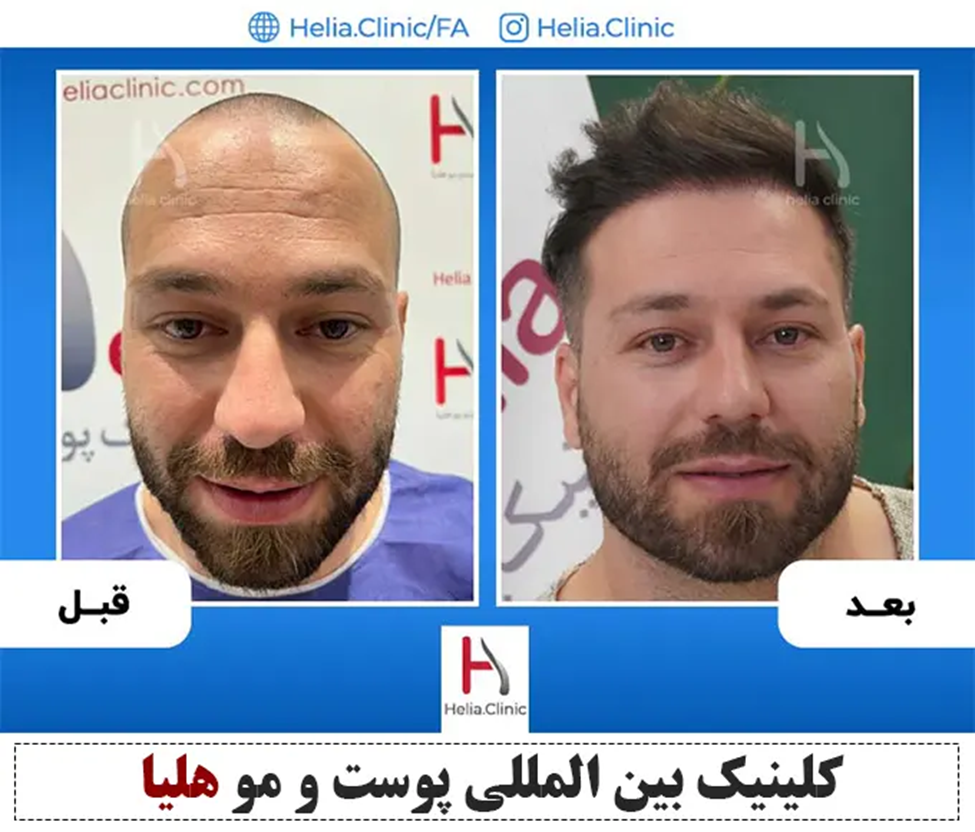 تغییر چهره جالب بعد از کاشت مو (یکسال بعد از کاشت)