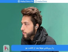 تغییر چهره جالب بعد از کاشت مو (یکسال بعد از کاشت)