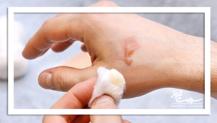 اگر بدنم سوخت چکار کنم؟ چکار نکنم؟ اگر بدنم سوخت چکار کنم؟ چکار نکنم؟