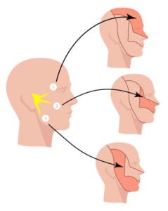 آیا دردهای عصب سه قلوی صورت قطعا برطرف میشوند؟