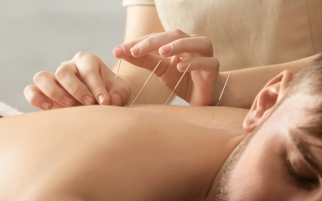 طب سوزنی راهکاری اثربخش برای نازایی و ناباروری