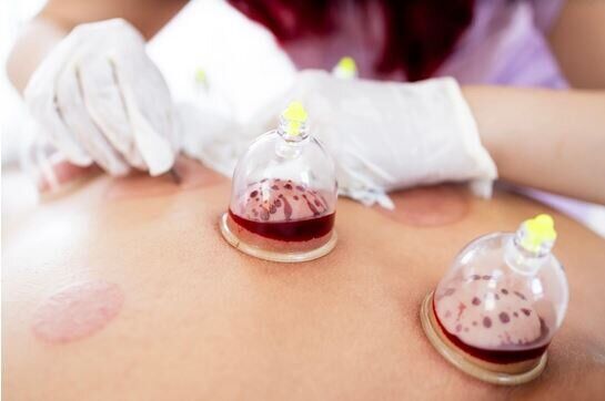 درمانهای دلهرهآور؛ از طب سوزنی زبان تا چکشکاریِ استخوانها