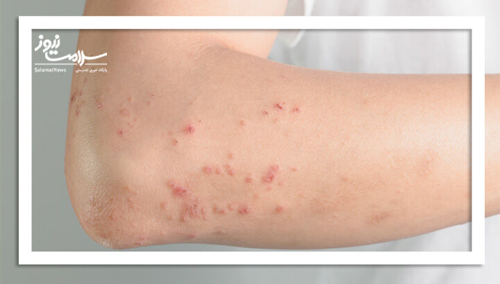 آیا HPV دلیل بثورات شماست؟ آیا HPV دلیل بثورات شماست؟