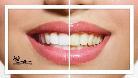 ۷ دلیل مهم برای زرد شدن دندان‌ها