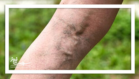 چگونه از واریس پیشگیری کنیم؟ با چند تغییر ساده!