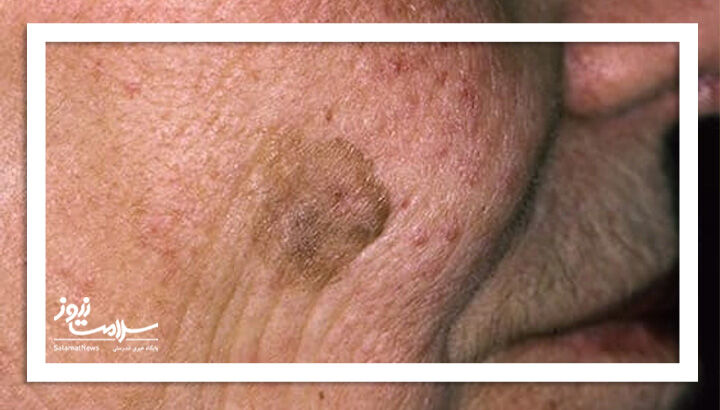 کراتوز سبورئیک