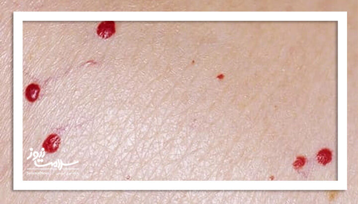 آنژیوم گیلاسی