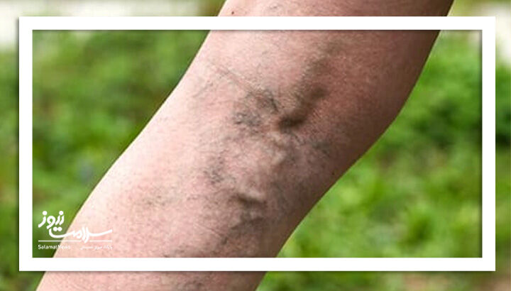 رگ های واریسی