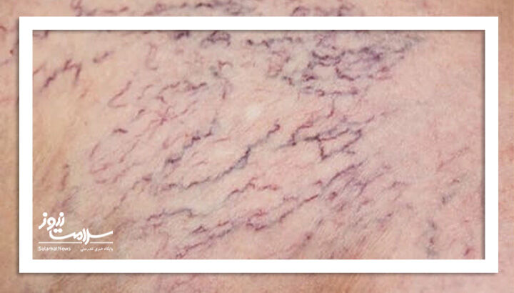 رگ های عنکبوتی