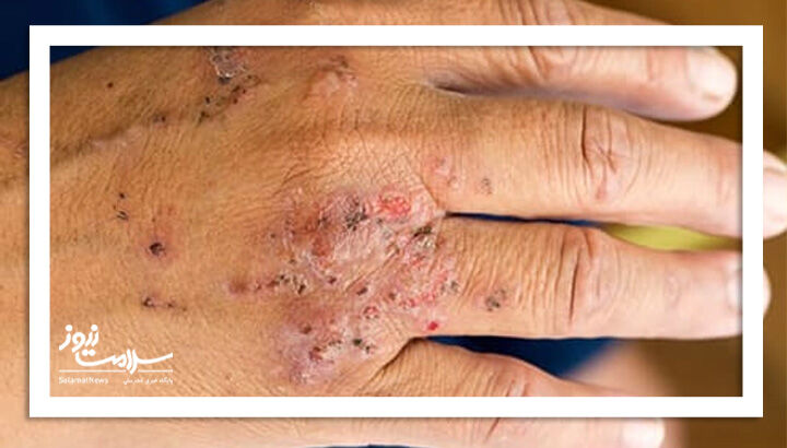 درماتیت تماسی