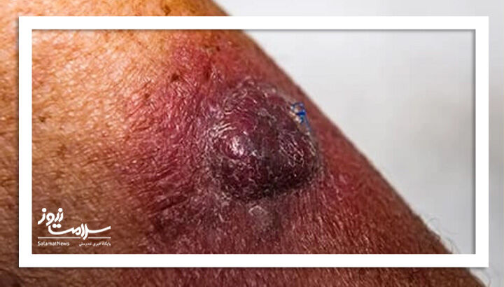سرطان پوست