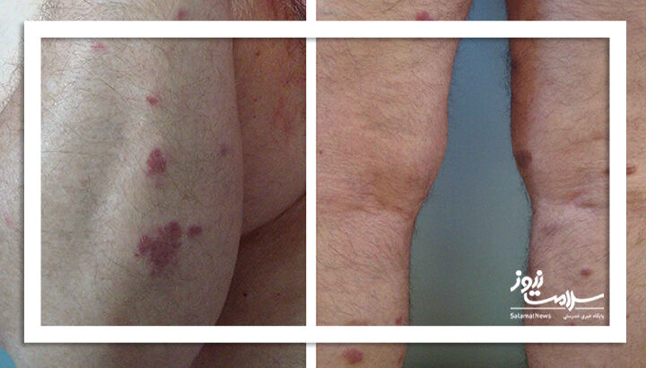 سارکوم کاپوزی