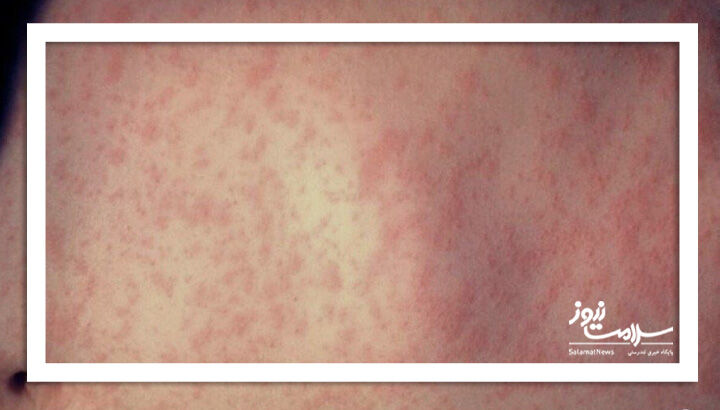 سروکانورژن