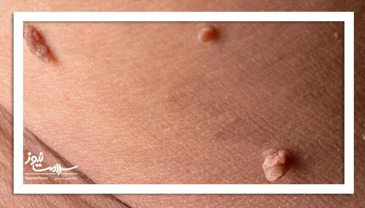 زگیل تناسلی