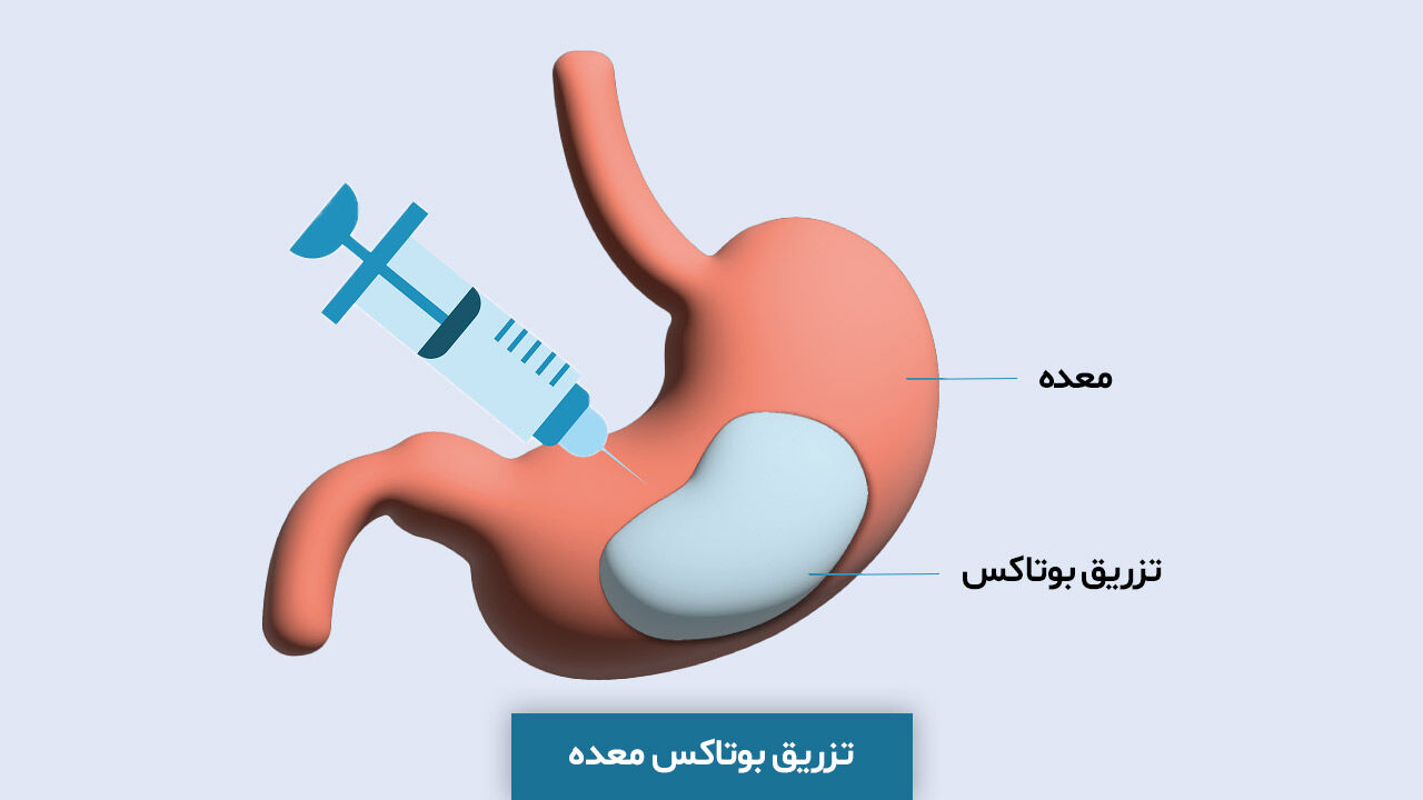 بوتاکس معده چیست و چطور باعث لاغری می شود(مزایا+عوارض)