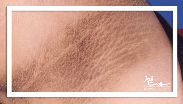 آکانتوز نیگریکانس