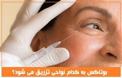 بوتاکس چیست و به کدام نواحی تزریق می شود؟