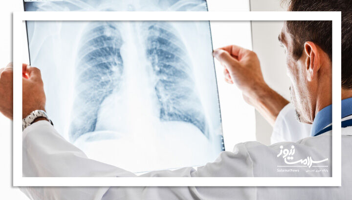 شکستگی دنده