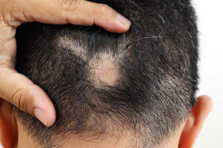 آلوپسی آره آتا چیست و چه علائمی دارد؟ آلوپسی آره آتا چیست و چه علائمی دارد؟