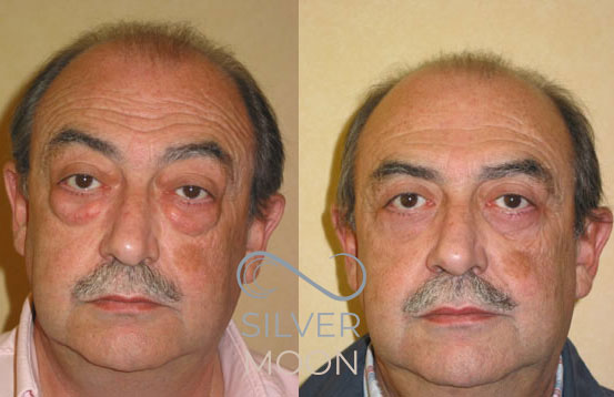 روشهای موثر رفع افتادگی پلک به همراه بررسی مزایا، معایب و هزینهها