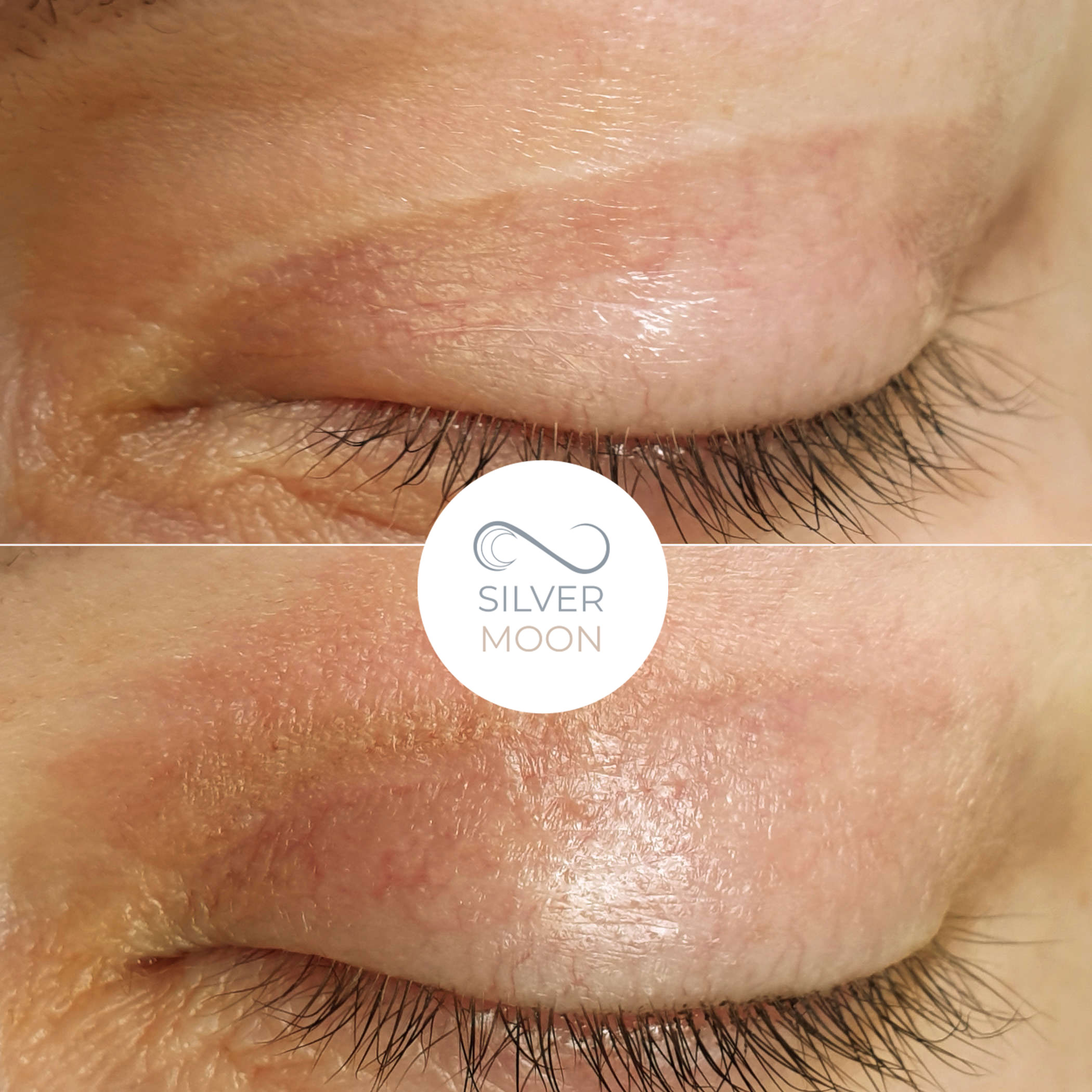 روشهای موثر رفع افتادگی پلک به همراه بررسی مزایا، معایب و هزینهها