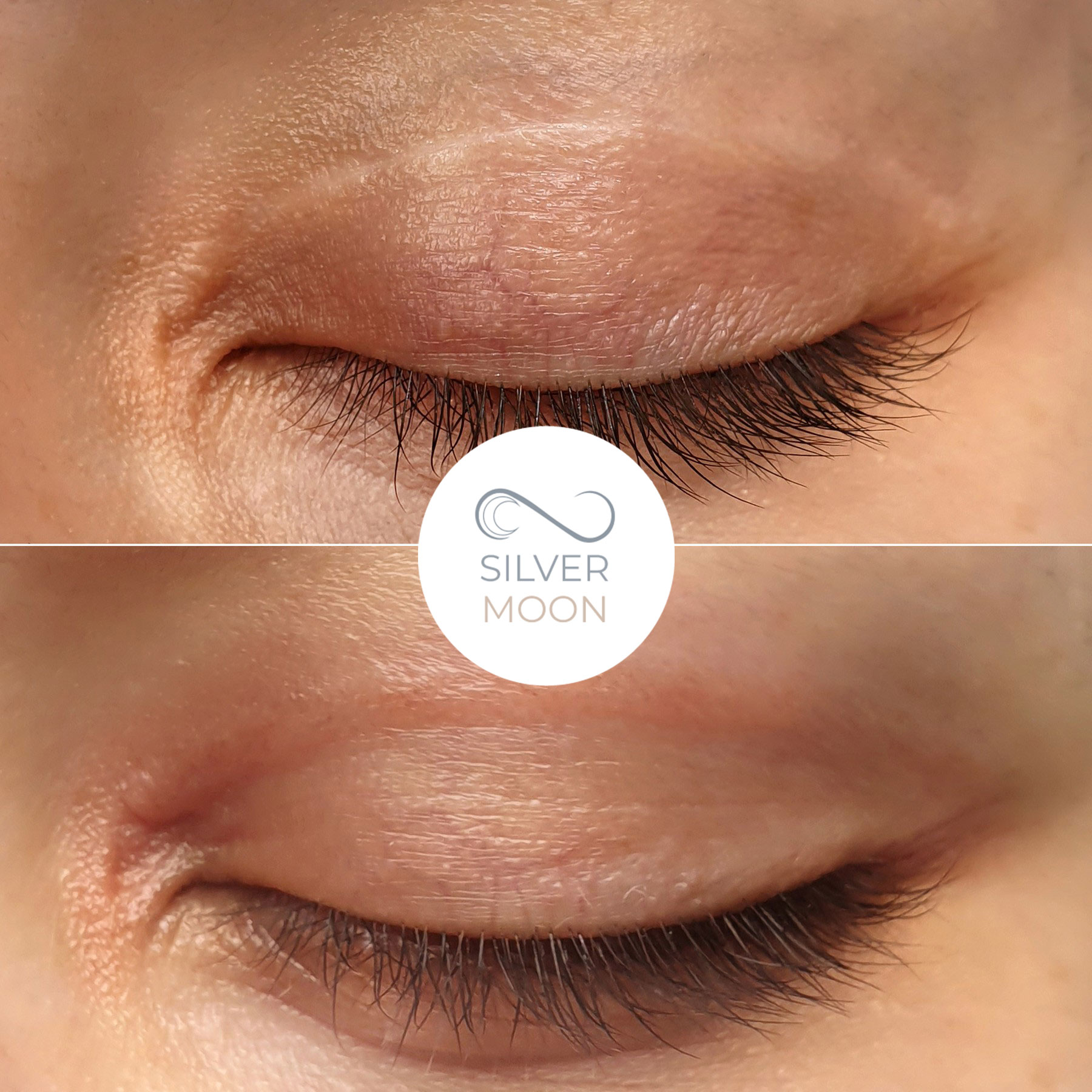 روشهای موثر رفع افتادگی پلک به همراه بررسی مزایا، معایب و هزینهها