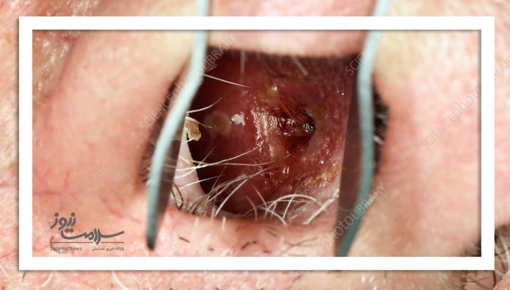 بلافاصله پس از بروز زخم در داخل بینی به پزشک مراجعه کنید