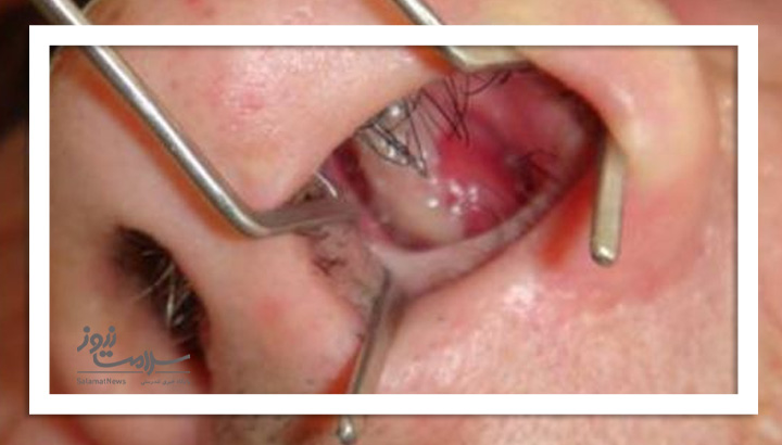 بلافاصله پس از بروز زخم در داخل بینی به پزشک مراجعه کنید