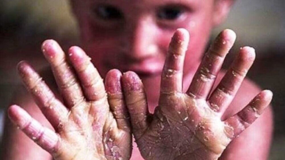 فراخوان سازمان غذا و دارو برای تامین پانسمانهای بیماران پروانهای فراخوان سازمان غذا و دارو برای تامین پانسمانهای بیماران پروانهای