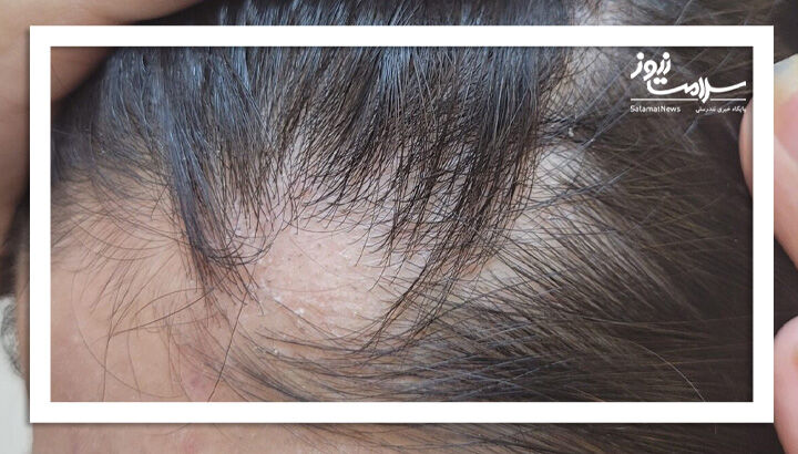 هورمون دیاچتی (DHT) چطور باعث ریزش مو می شود؟ هورمون دیاچتی (DHT) چطور باعث ریزش مو می شود؟