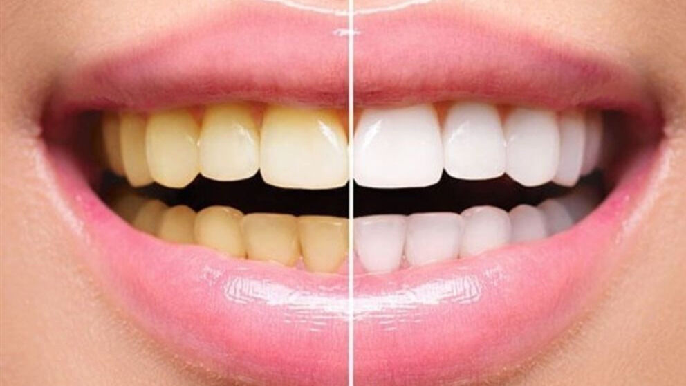 در چه سنی لمینت دندان کنیم؟ در چه سنی لمینت دندان کنیم؟