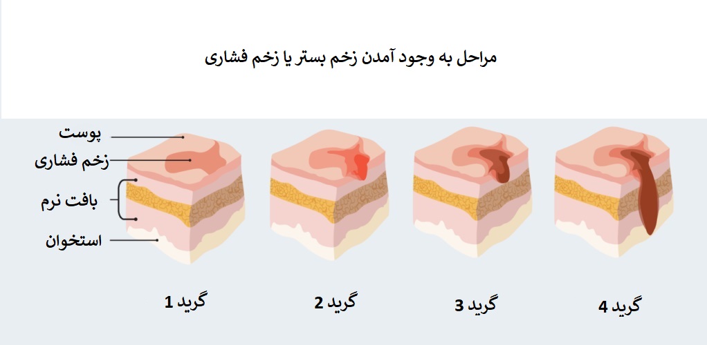 زخم بستر دیابتی