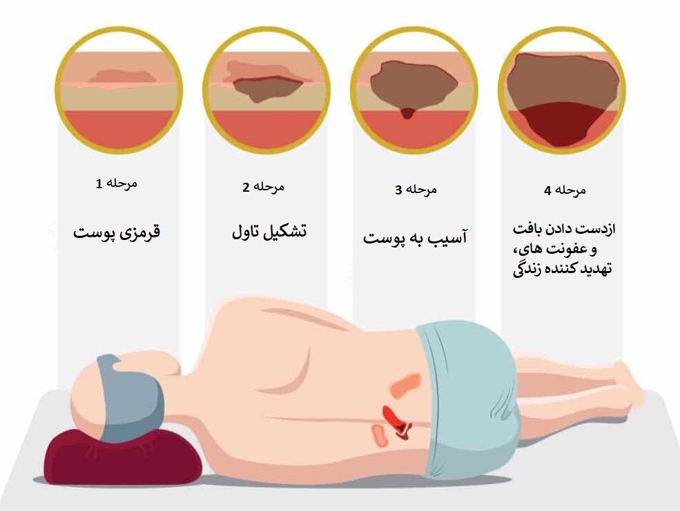 زخم بستر دیابتی