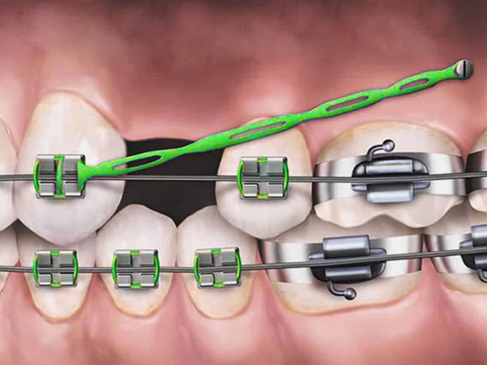 عوامل موثر بر زمان پر شدن جای دندان خالی در ارتودنسی