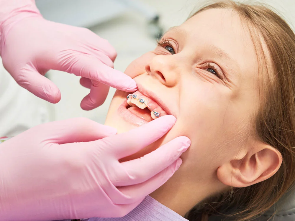 مراحل پر شدن جای دندان کشیده شده در ارتودنسی