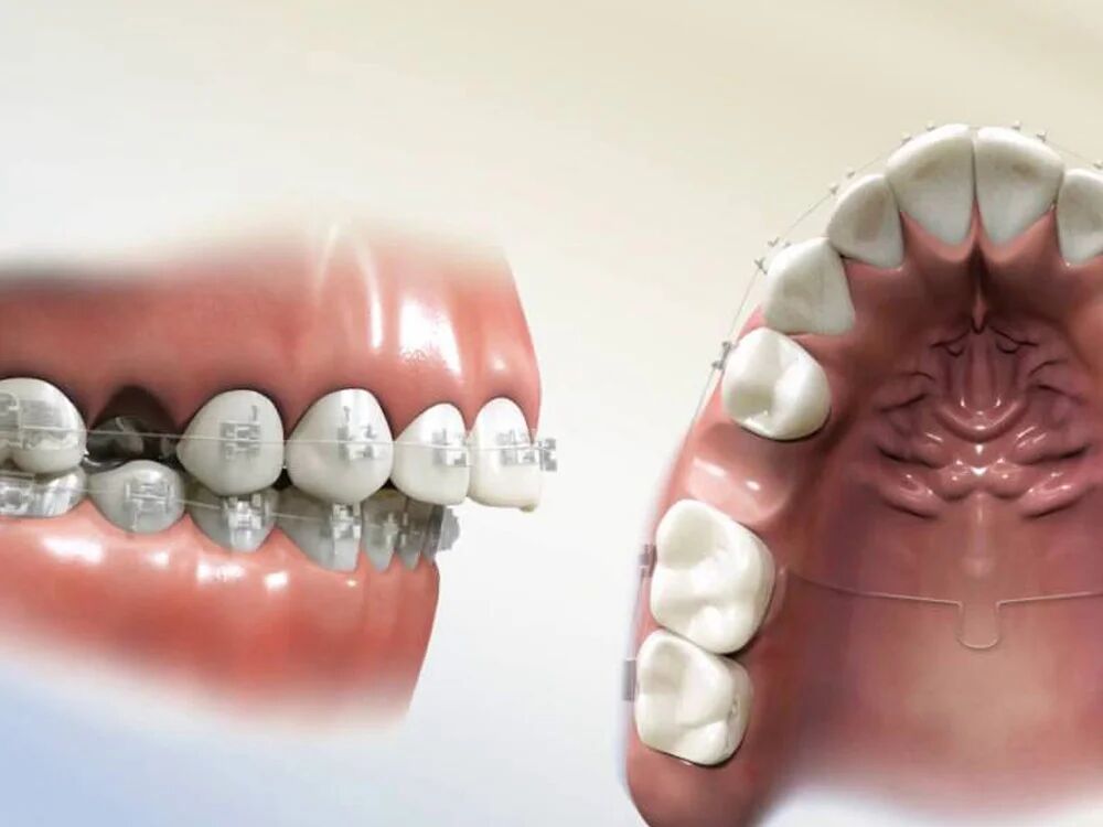 پر شدن جای خالی دندان کشیده شده با ارتودنسی چقدر طول میکشد؟ مدت زمان پر شدن جای دندان کشیده شده با ارتودنسی