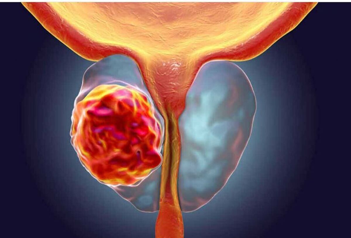 رژیم غذایی سالم:راهکار طلایی برای کنترل بیماری پروستات رژیم غذایی سالم:راهکار طلایی برای کنترل بیماری پروستات