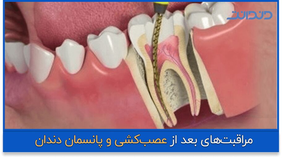 مراقبت های بعد از پانسمان دندان