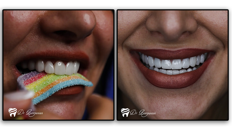 آیا میتوانیم در دوران بارداری از لمینت دندان استفاده کنیم؟